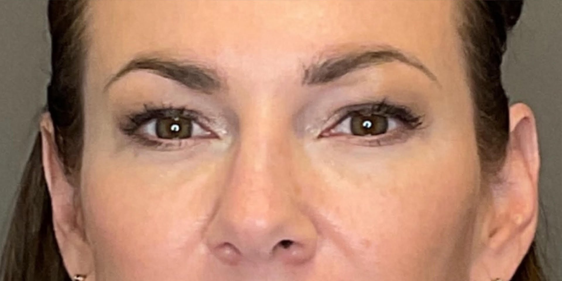 PDGF Before & After Gallery - Patient 258676 - Image 2