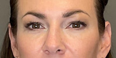 PDGF Before & After Gallery - Patient 258676 - Image 2