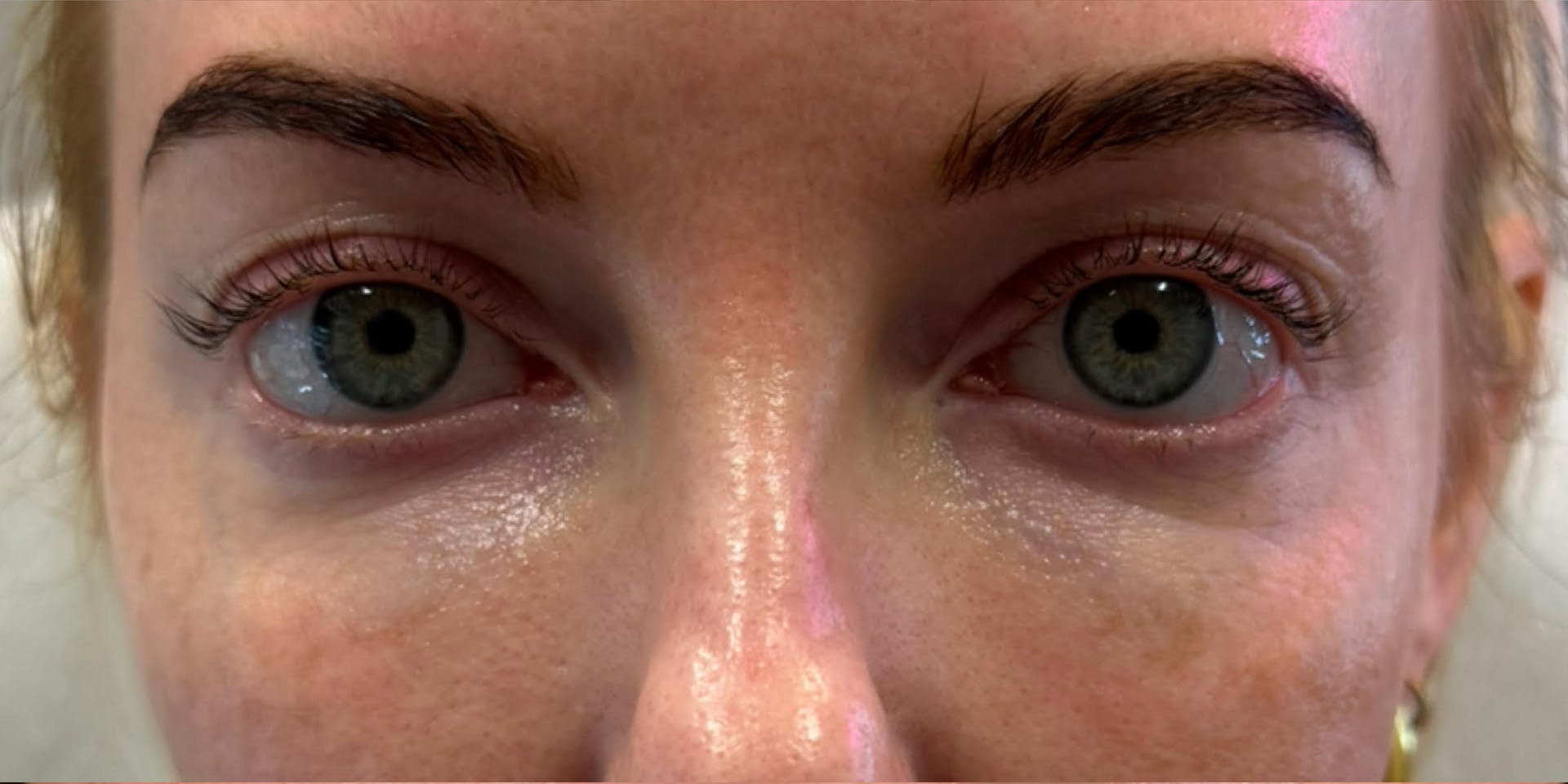 PDGF Before & After Gallery - Patient 287083 - Image 2