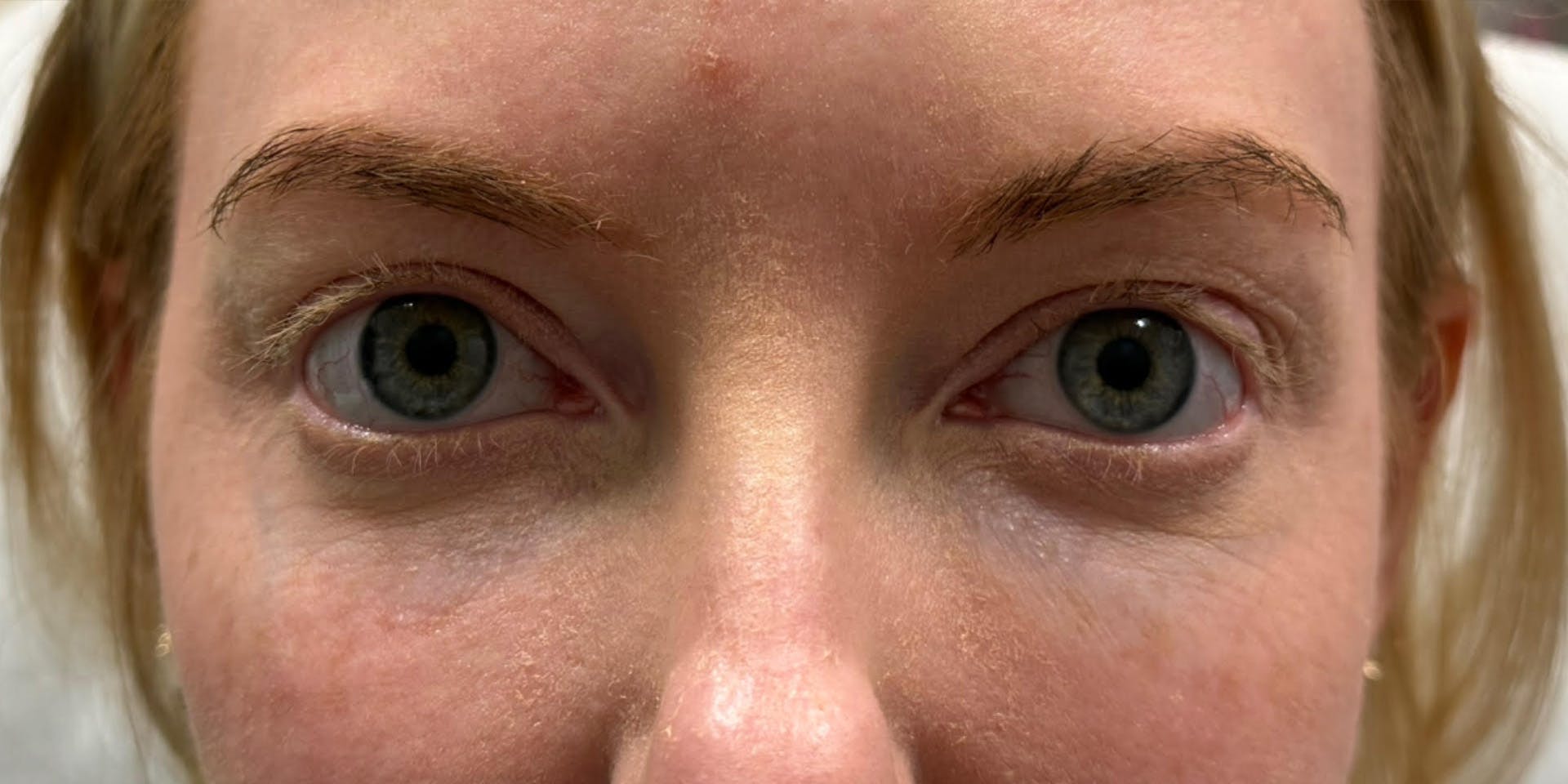 PDGF Before & After Gallery - Patient 287083 - Image 1