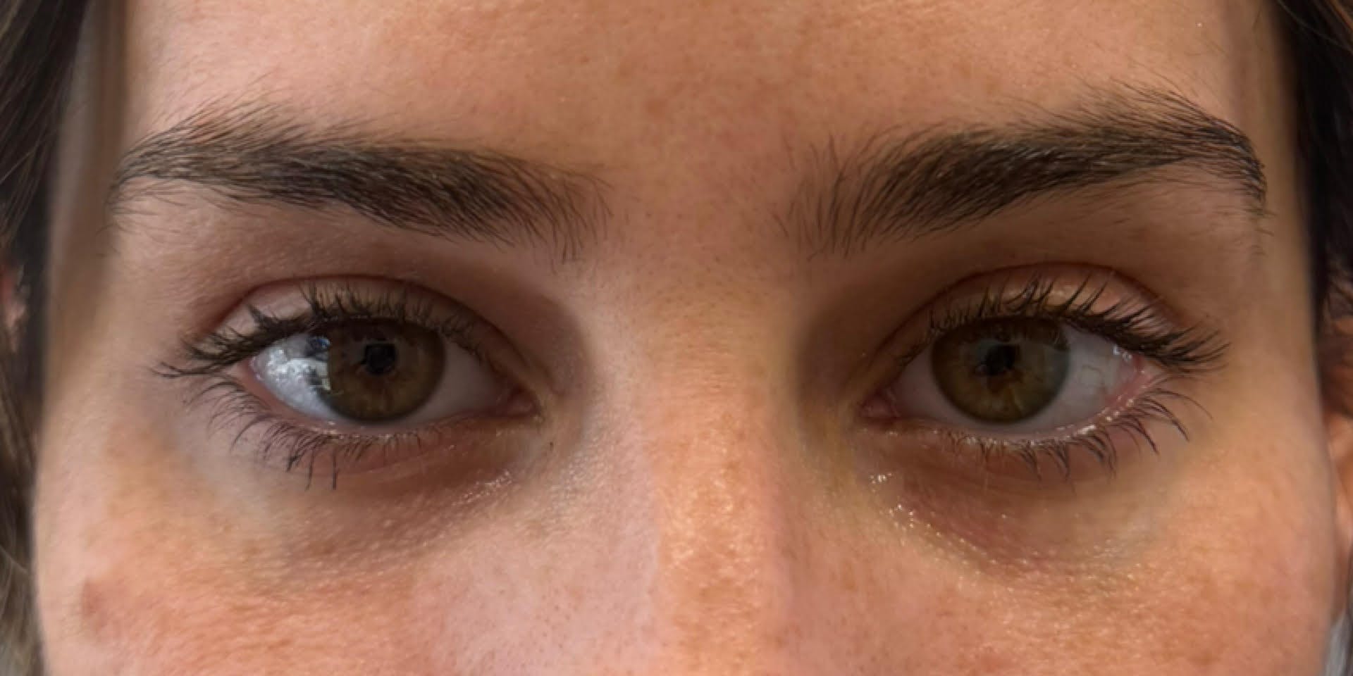 PDGF Before & After Gallery - Patient 336162 - Image 1