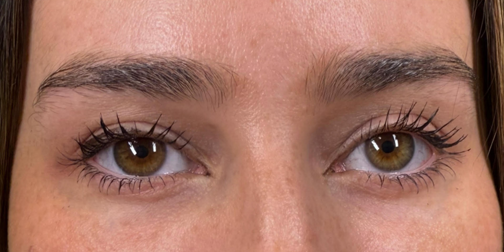 PDGF Before & After Gallery - Patient 336162 - Image 2