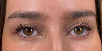 PDGF Before & After Gallery - Patient 336162 - Image 2