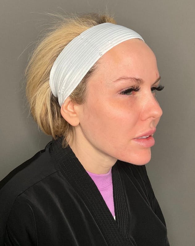 Contoured Mini Neck Lift Before & After Gallery - Patient 121911 - Image 2