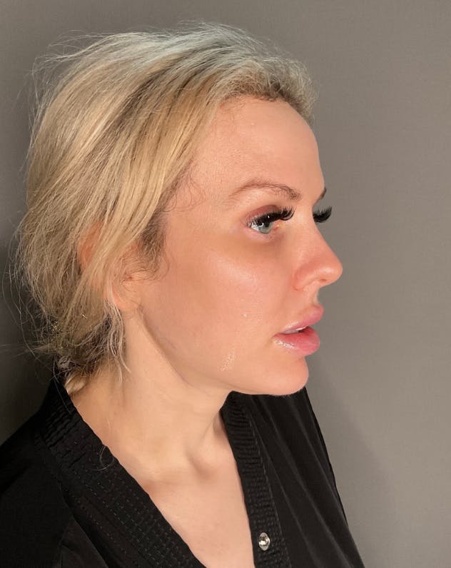 Contoured Mini Neck Lift Before & After Gallery - Patient 121911 - Image 1