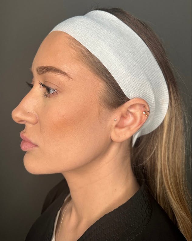 Contoured Mini Neck Lift Before & After Gallery - Patient 164238 - Image 2