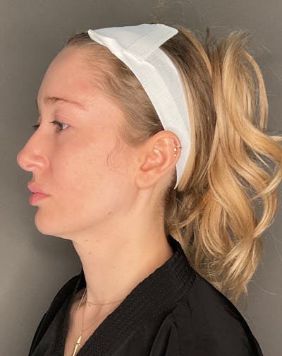 Contoured Mini Neck Lift Before & After Gallery - Patient 164238 - Image 1