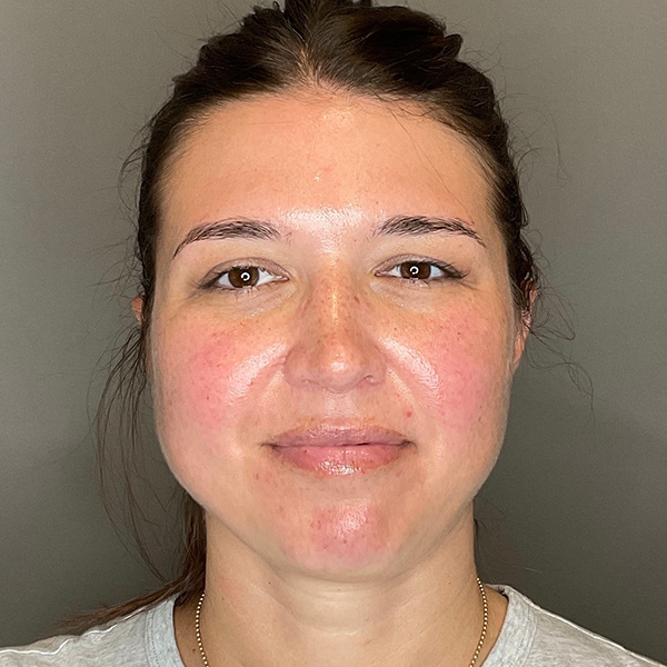 BOTOX Before & After Gallery - Patient 348690 - Image 1