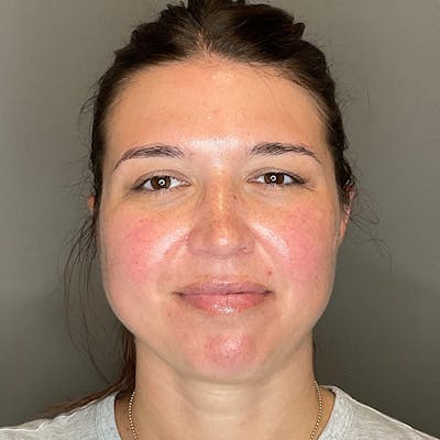 BOTOX Before & After Gallery - Patient 348690 - Image 1