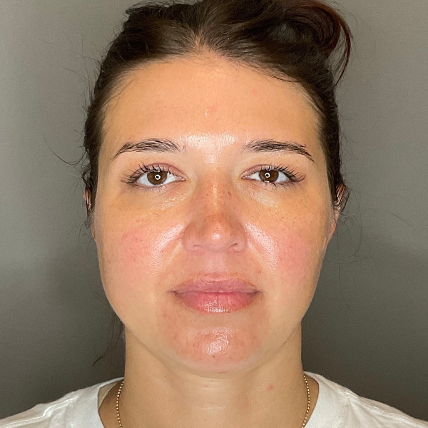 BOTOX Before & After Gallery - Patient 348690 - Image 2