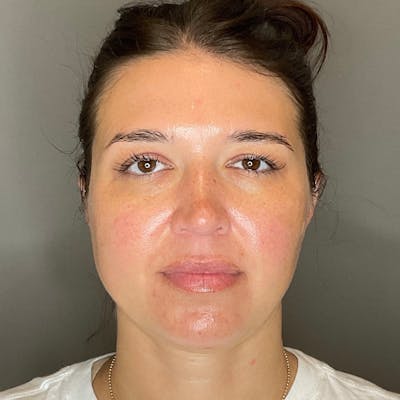 BOTOX Before & After Gallery - Patient 348690 - Image 2