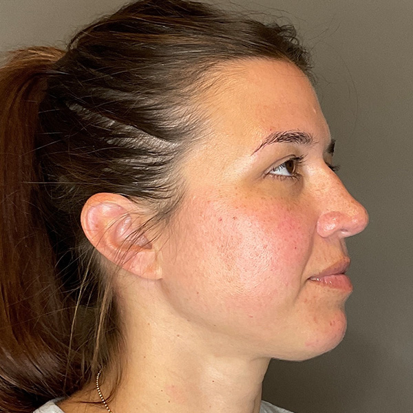 BOTOX Before & After Gallery - Patient 348690 - Image 3