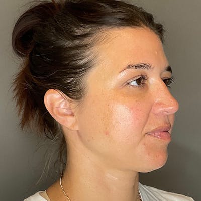 BOTOX Before & After Gallery - Patient 348690 - Image 4