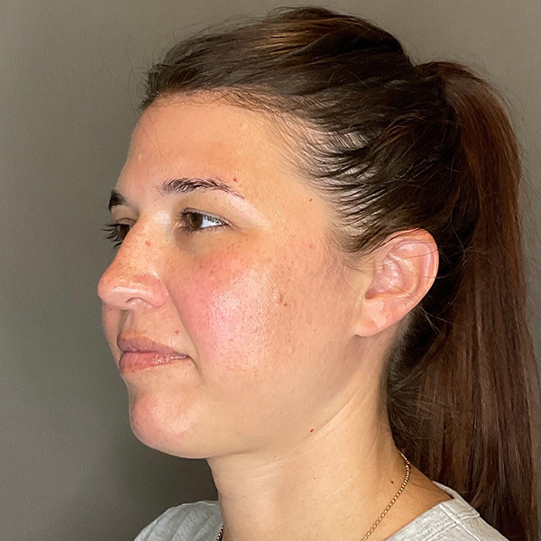 BOTOX Before & After Gallery - Patient 348690 - Image 5