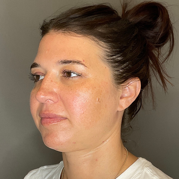 BOTOX Before & After Gallery - Patient 348690 - Image 6