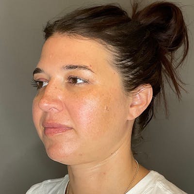 BOTOX Before & After Gallery - Patient 348690 - Image 6