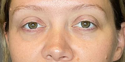 PDGF Before & After Gallery - Patient 291922 - Image 1