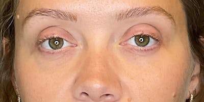 PDGF Before & After Gallery - Patient 291922 - Image 2