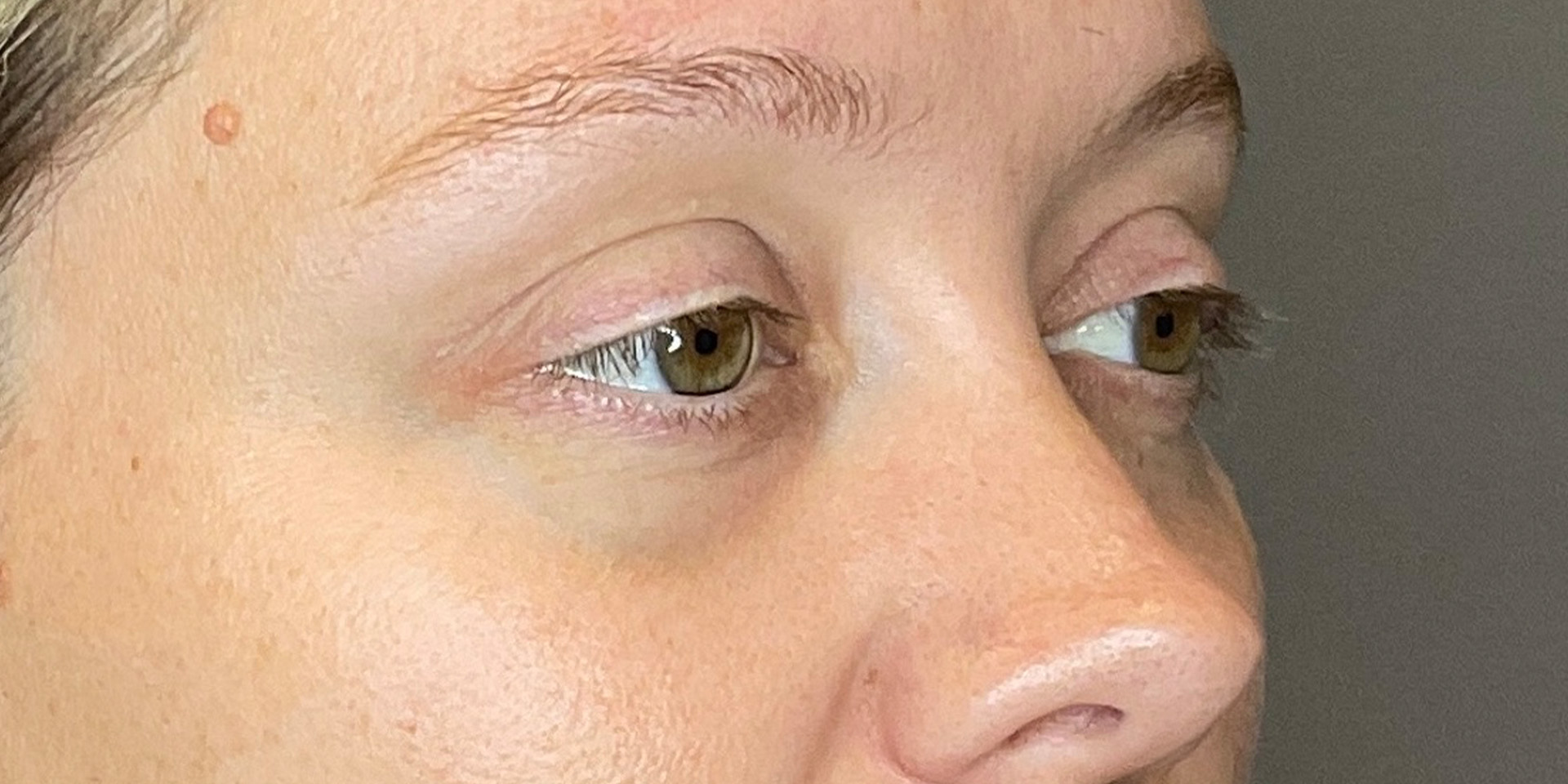 PDGF Before & After Gallery - Patient 291922 - Image 3