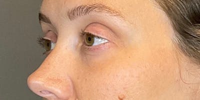 PDGF Before & After Gallery - Patient 291922 - Image 6
