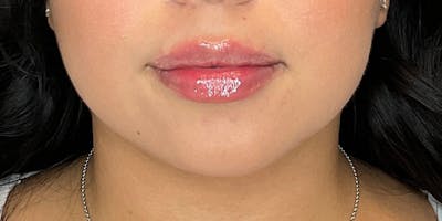 Lip Fillers Before & After Gallery - Patient 388098 - Image 2