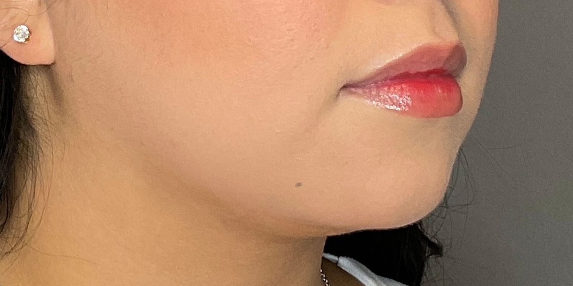 Lip Fillers Before & After Gallery - Patient 388098 - Image 3