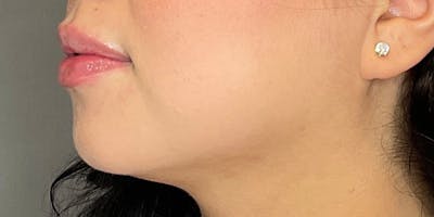 Lip Fillers Before & After Gallery - Patient 388098 - Image 6