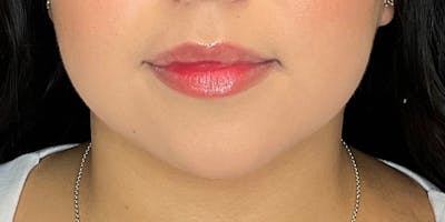Lip Fillers Before & After Gallery - Patient 388098 - Image 1