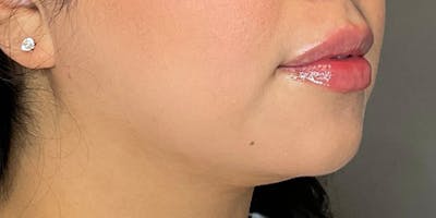 Lip Fillers Before & After Gallery - Patient 388098 - Image 4