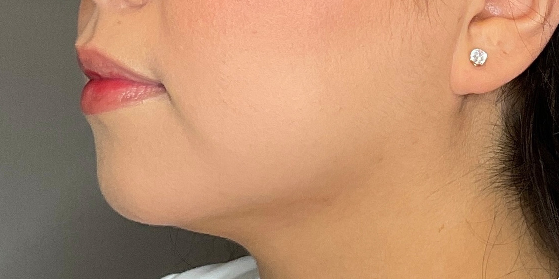 Lip Fillers Before & After Gallery - Patient 388098 - Image 5