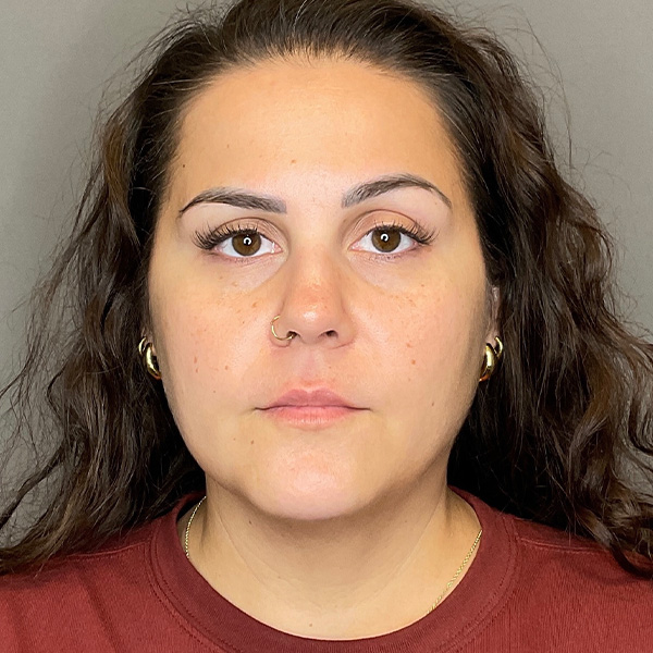 BOTOX Before & After Gallery - Patient 133495 - Image 1