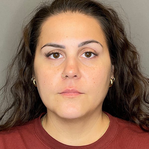 BOTOX Before & After Gallery - Patient 133495 - Image 1