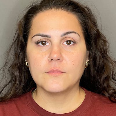 BOTOX Before & After Gallery - Patient 133495 - Image 1
