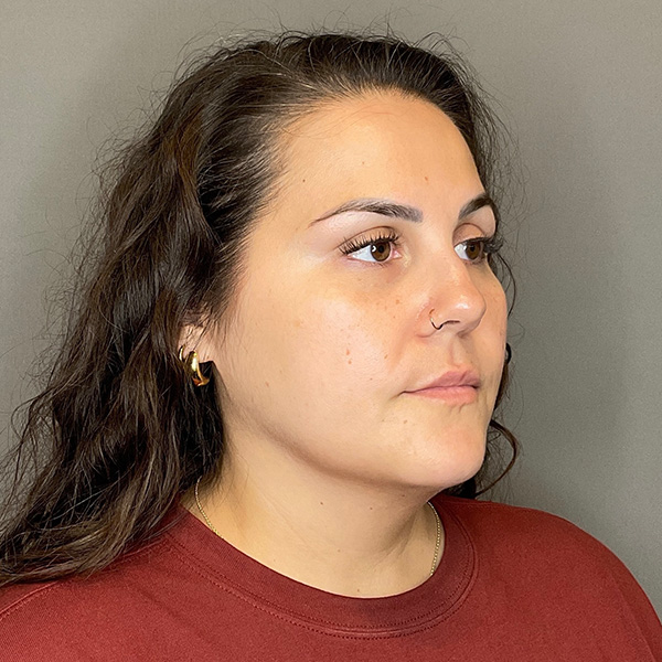 BOTOX Before & After Gallery - Patient 133495 - Image 3