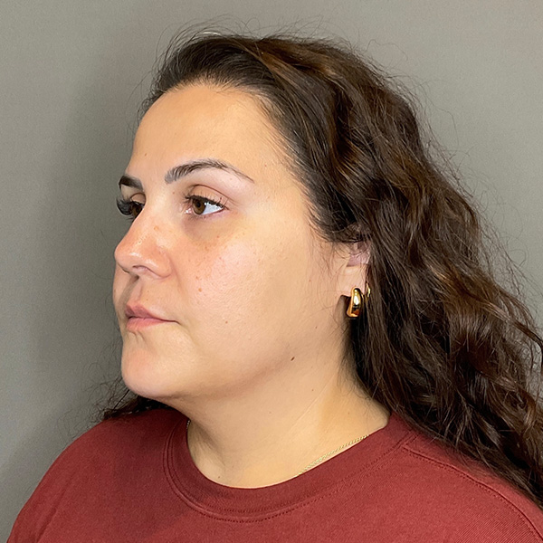 BOTOX Before & After Gallery - Patient 133495 - Image 5