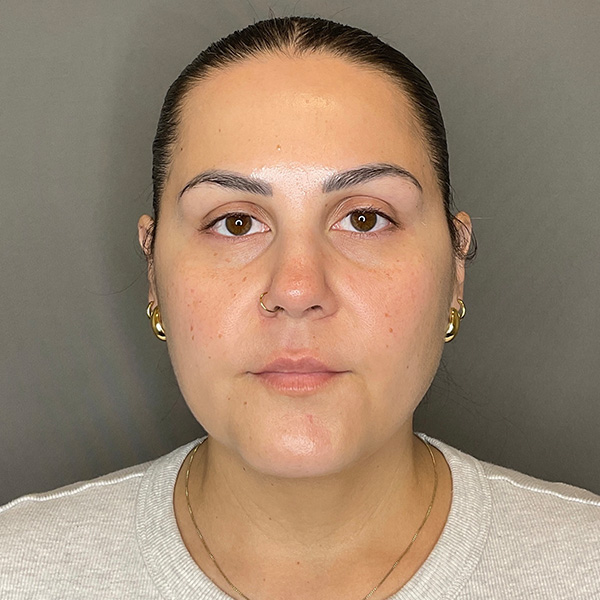 BOTOX Before & After Gallery - Patient 133495 - Image 2