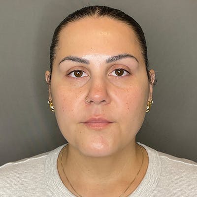 BOTOX Before & After Gallery - Patient 133495 - Image 2