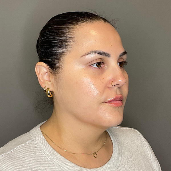 BOTOX Before & After Gallery - Patient 133495 - Image 4