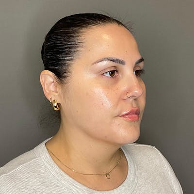 BOTOX Before & After Gallery - Patient 133495 - Image 4