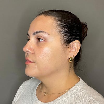 BOTOX Before & After Gallery - Patient 133495 - Image 6