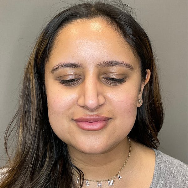 Microneedling with SkinPen Before & After Gallery - Patient 126555 - Image 1