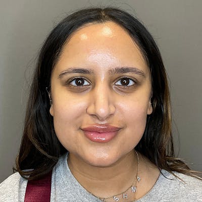 Microneedling with SkinPen Before & After Gallery - Patient 126555 - Image 2