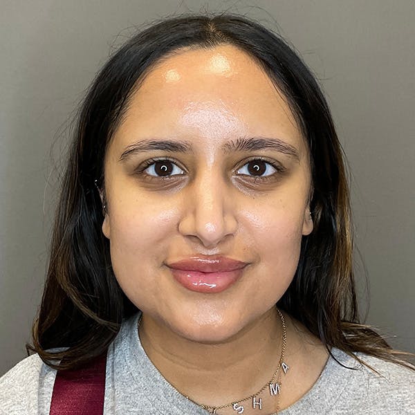 Microneedling with SkinPen Before & After Gallery - Patient 126555 - Image 2