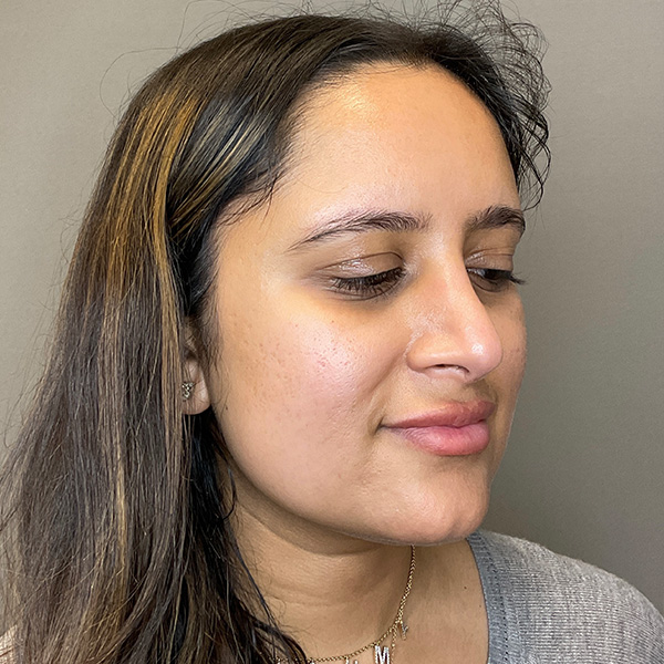 Microneedling with SkinPen Before & After Gallery - Patient 126555 - Image 3