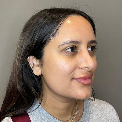 Microneedling with SkinPen Before & After Gallery - Patient 126555 - Image 4