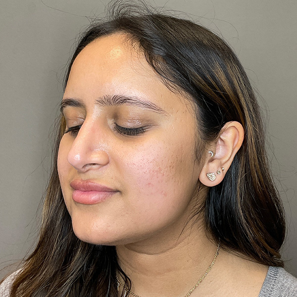 Microneedling with SkinPen Before & After Gallery - Patient 126555 - Image 5