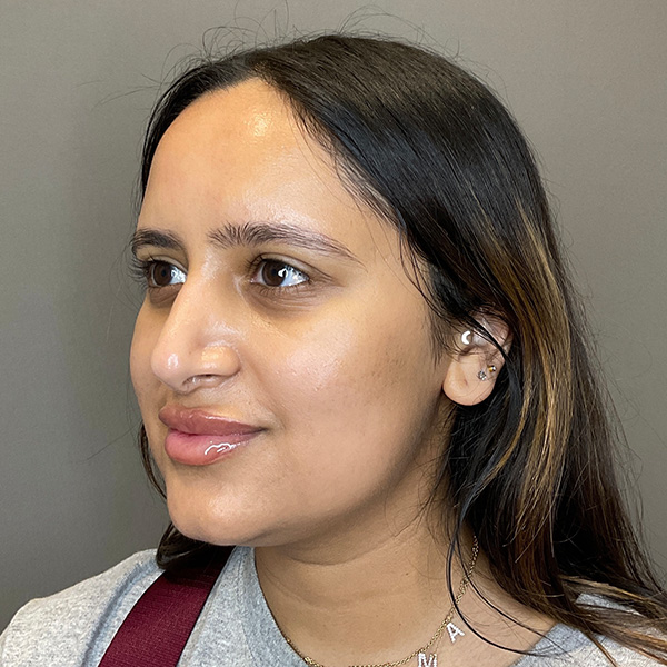 Microneedling with SkinPen Before & After Gallery - Patient 126555 - Image 6