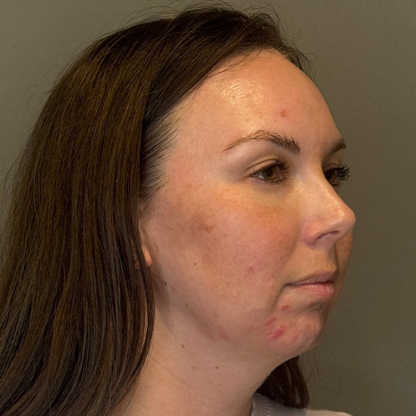 BioRePeel Before & After Gallery - Patient 450555 - Image 3
