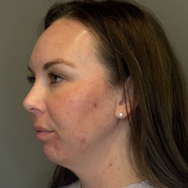 BioRePeel Before & After Gallery - Patient 450555 - Image 5