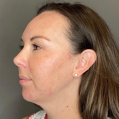 BioRePeel Before & After Gallery - Patient 450555 - Image 6